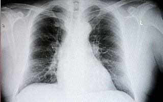 Choroby układu oddechowego